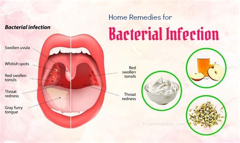 Mouth Bacteria Infection