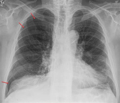 Pneumothorax - Radiology For Beginners by Dr. Samuel Kobba