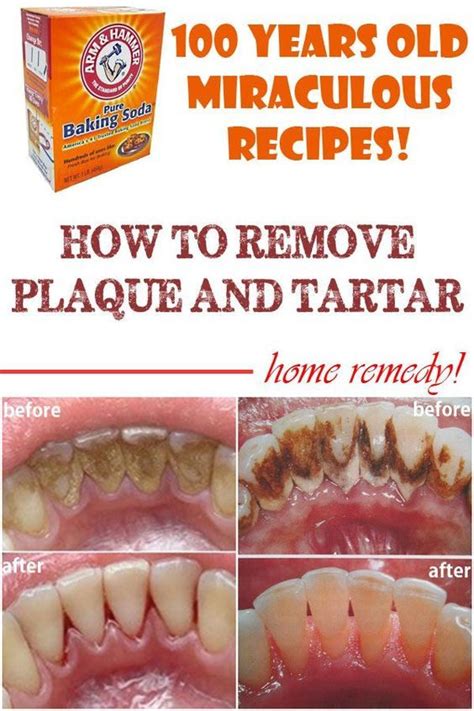 Home remedies to remove plaque and tartar-Tartar can manifest in ...