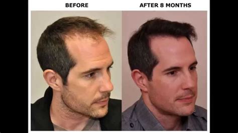 BEFORE & AFTER Hair Transplant Using ARTAS Robot for FUE - YouTube