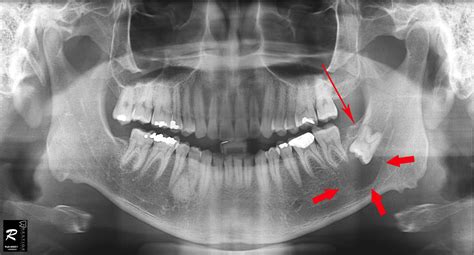 Wisdom Teeth Surgery: Cases That Was Done in Our Clinic – prestige-dental-care.com.my