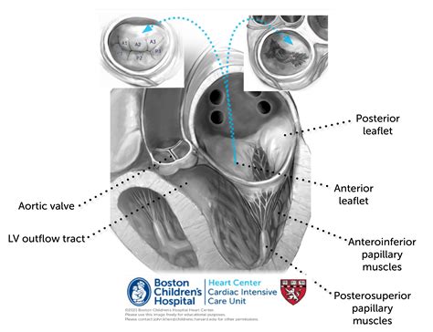 Mitral Valve Pathologies – Online supplement