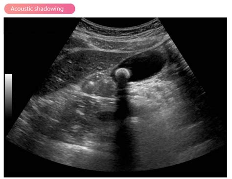 Artifacts in ultrasound imaging – Cardiovascular Education