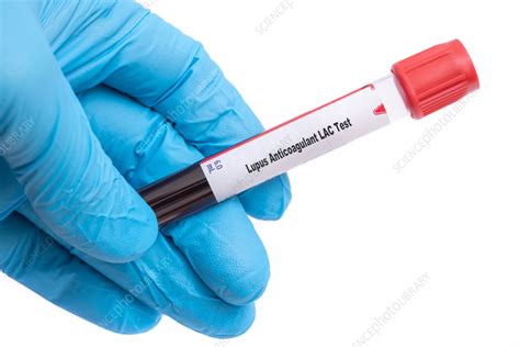 Lupus anticoagulant test, conceptual image - Stock Image - F037/0498 ...