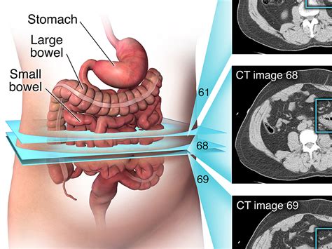 Medmovie.com | Misdiagnosed Perforated Bowel