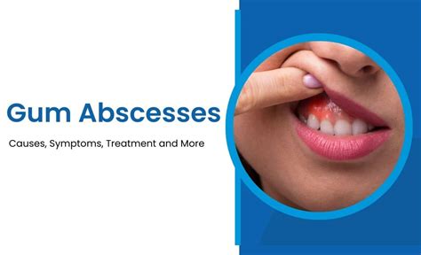 Gum Abscesses: Causes, Symptoms, Treatment and More - Resurchify