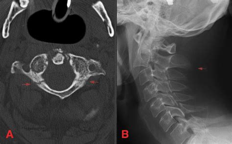 Avulsion Fracture Cervical Spine