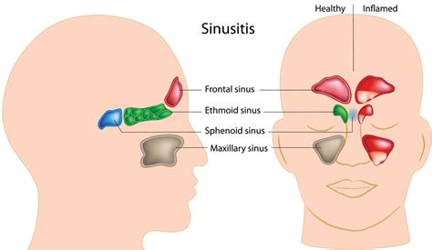 Acute and Chronic Sinusitis and Allergies