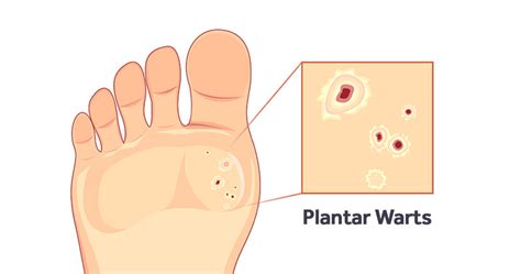 Treatment and Removal of Plantar Warts - Kids' Foot Health