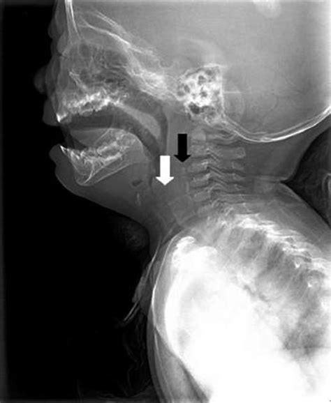 Lateral Soft Tissue Neck X Ray