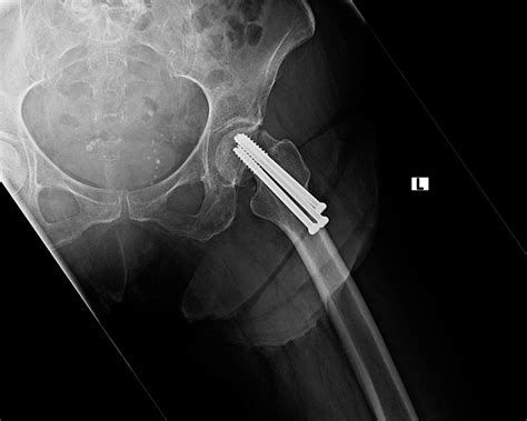 Ortho Dx: Failed Hip Pinning - Clinical Advisor