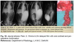 TRIPPLE BUBBLE (JEJUNAL ATRESIA) – radiologi.id