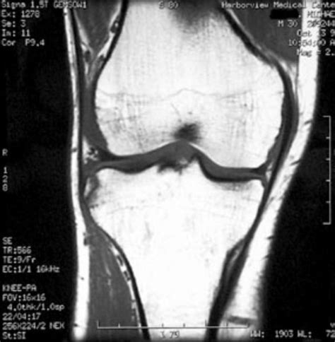 Anterior cruciate ligament injury - wikidoc