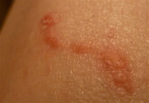 Scabies Images – Scabies Authority