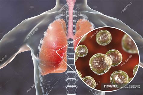 Human silhouette with infected lungs with Pulmonary blastomycosis and close-up of Blastomyces ...