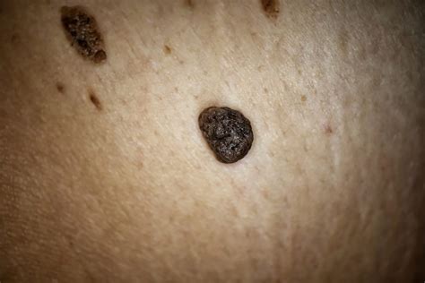 Recolectar 118+ images skin cancer black mole - Viaterra.mx