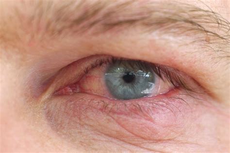 Eye infection / Infection of an eyelid on an eye with contact lens | Daily Health Alerts