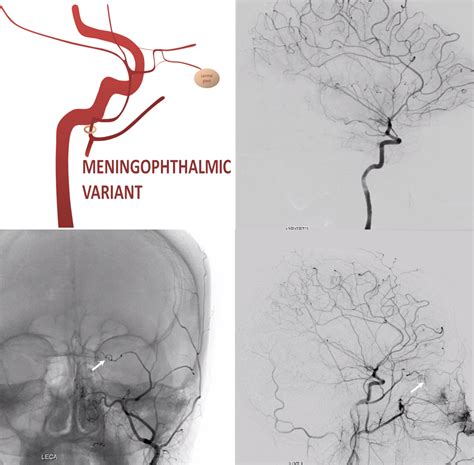 Subdural Hematoma Embolization | neuroangio.org