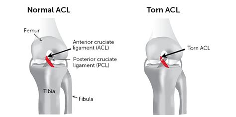 Knee Ligament Injury – ACL Rehabilitation | Body Works Sports Physiotherapy