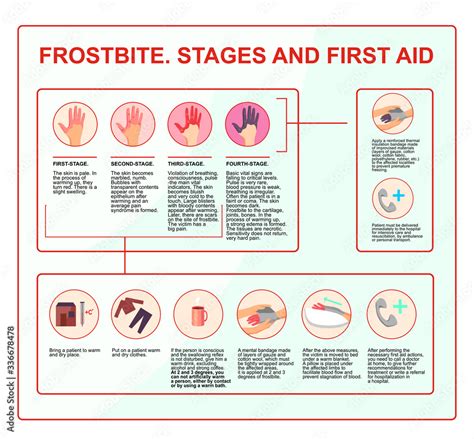 Frostbite - symptoms, protection and treatment. infographics illustration in vector. First aid ...