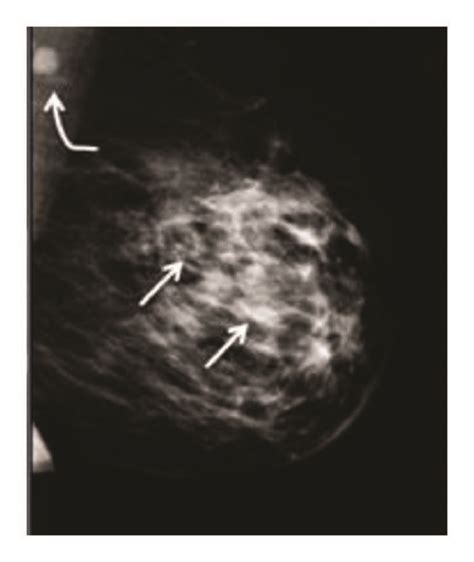 Mammogram images of a fatty breast and a heterogeneously dense breast ...