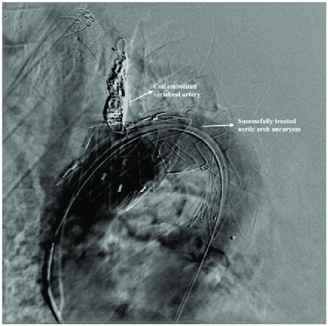 Coil embolization in a patient with type 2 endoleak. | Download ...