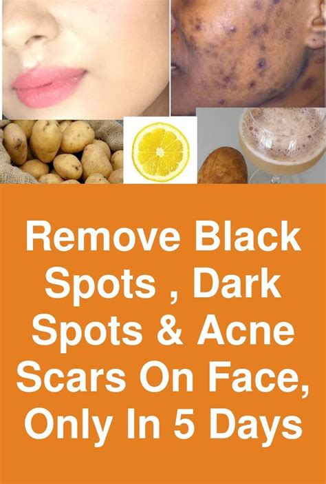 How To Remove Dark Spots On Face And Pimples - HOWTOREMVO