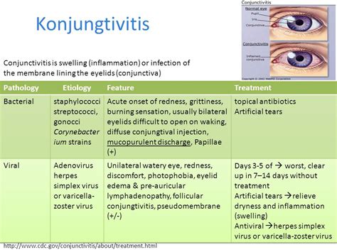 Conjunctivitis treatment antibiotic eye drops