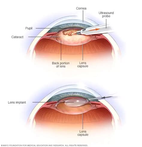 Glaucoma vs. Cataracts: What’s the Difference? - Responsum Health