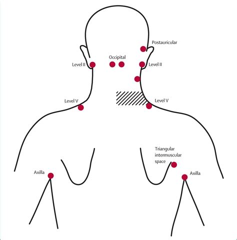 Lymphatic mapping in management of patients with primary cutaneous ...