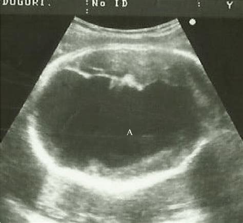 Hydranencephaly Ultrasound