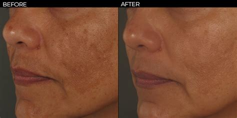 Best Melasma/Hyper-Pigmentation Treatment in Delhi, West Delhi ...