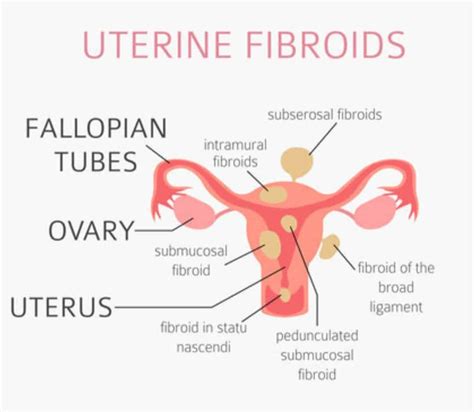 Current Cost of Fibroid Surgery in Nigeria Today: All You Need to Know