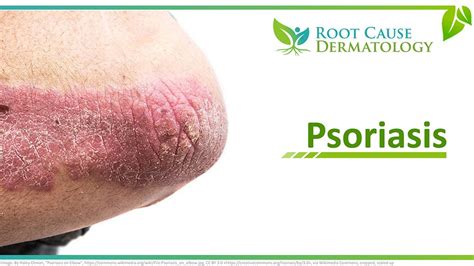 Natural Treatments for Psoriasis | Dermatologist Los Angeles