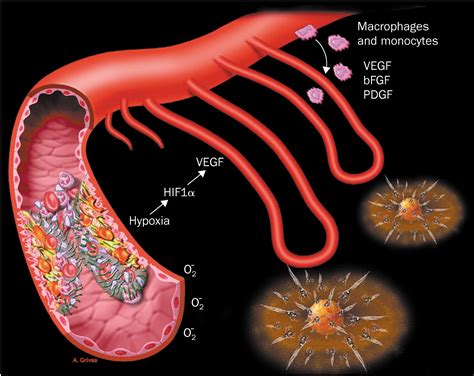 Alzheimer's disease and angiogenesis - The Lancet