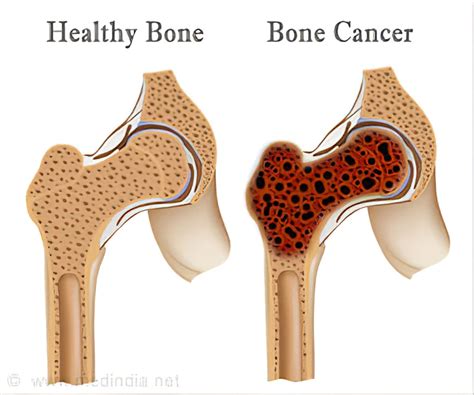 Bone Cancer(sarcoma) - Purwanchal Cancer Hospital