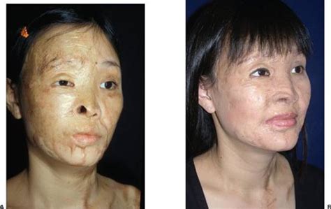 PRINCIPLES OF BURN RECONSTRUCTION - Grabb and Smith's Plastic Surgery ...