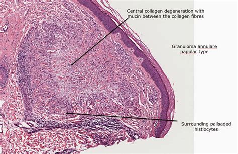 Dermatopathology Made Simple - Inflammatory: Granulomatous Reaction Pattern