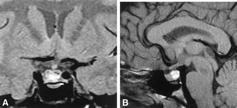 Radiological appearance of xanthomatous hypophysitis on MRI. The... | Download Scientific Diagram