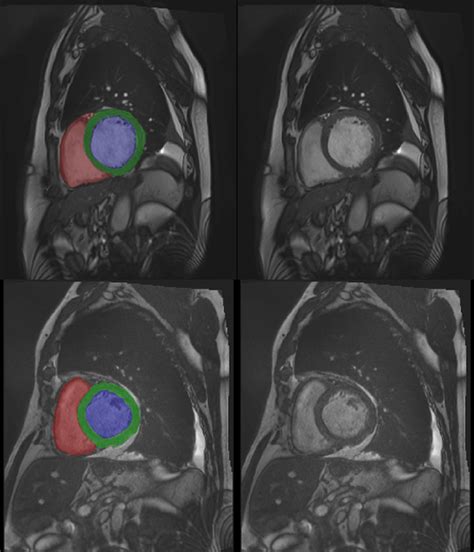 3D Cardiac MRI automatic segmentation by RSIP Vision