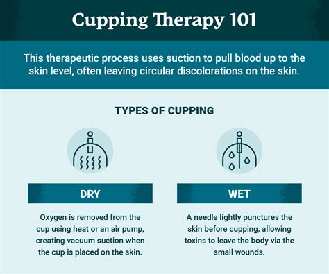 What Is Cupping Therapy? Benefits and Applications | USAHS