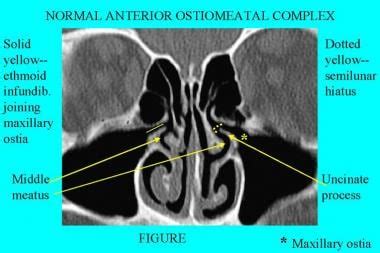 Ct Sinuses Anatomy - Anatomical Charts & Posters