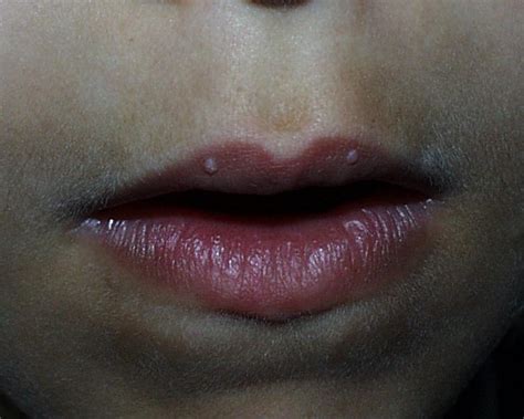 warts on lips - pictures, photos