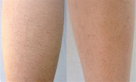 Laser Hair Removal in Nashville - Curcio Dermatology