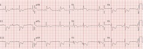 Dr. Smith's ECG Blog: Beware crescendo angina in patient with known CAD