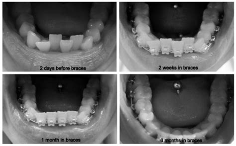 Progress Pics - 6 Months in Braces | emBRACING it - a braces and jaw surgery diary