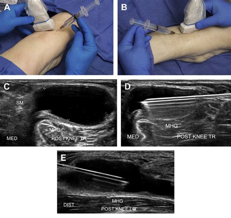 Figure 8 from Ultrasound-Guided Knee Procedures. | Semantic Scholar