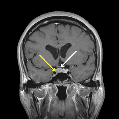 Pituitary: Pituitary Tumor Mri