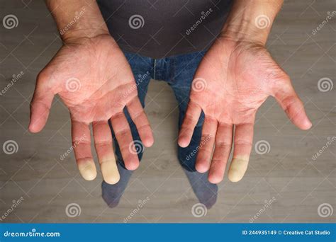 Man Showing Hands with Raynaud Syndrome, Raynaud S Phenomenon or Raynaud S Disease Stock Image ...