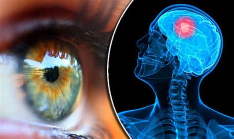 Brain Tumour Symptoms: 10 Unusual Signs That May Appear on Eyes And ...